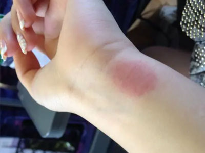 貼完出來(lái)很多小紅疙瘩，還特別癢，怎么回事？是過(guò)敏嗎？